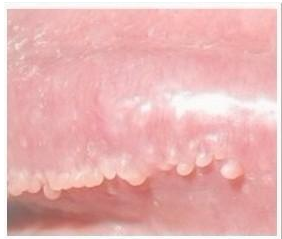 常见于阴茎珍珠疹,尖锐湿疣,包皮包茎(包皮垢)引起;如果出现小颗粒
